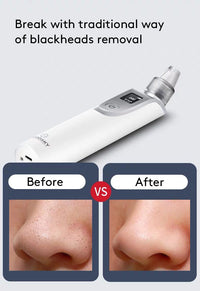 USB Charging Facial Blackhead Remover